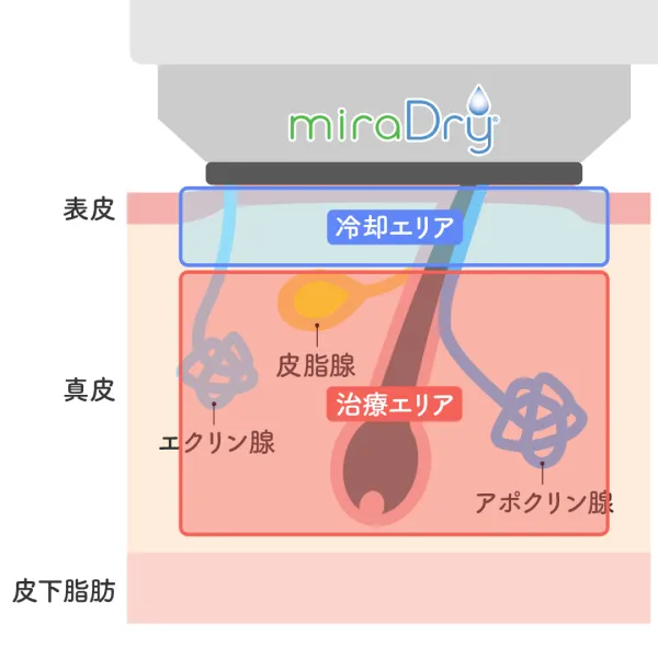 ミラドライの冷却機能により皮膚を保護